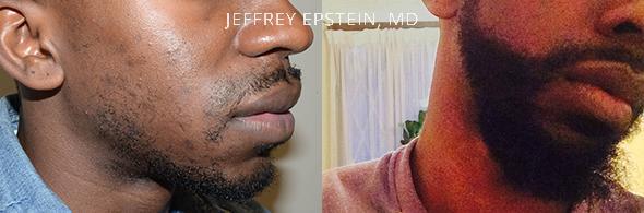 Facial Hair Transplant Before and after in Miami, FL, Paciente 37030