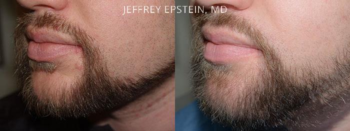 Facial Hair Transplant Before and after in Miami, FL, Paciente 37035