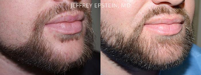 Facial Hair Before and after in Miami, FL, Paciente 37035