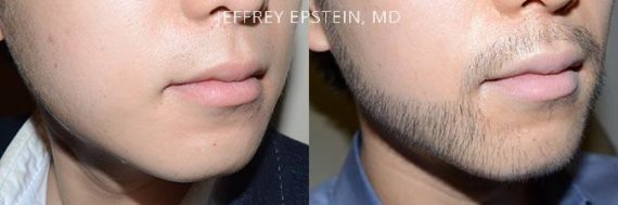 Facial Hair Before and after in Miami, FL, Paciente 37042