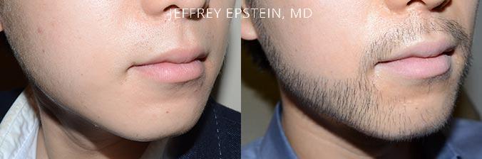 Facial Hair Transplant Before and after in Miami, FL, Paciente 37042
