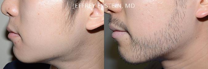 Facial Hair Transplant Before and after in Miami, FL, Paciente 37042