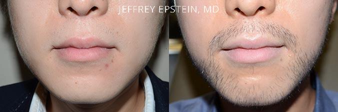 Trasplante de Pelo Facial Antes y después en Miami, FL, Paciente 71346