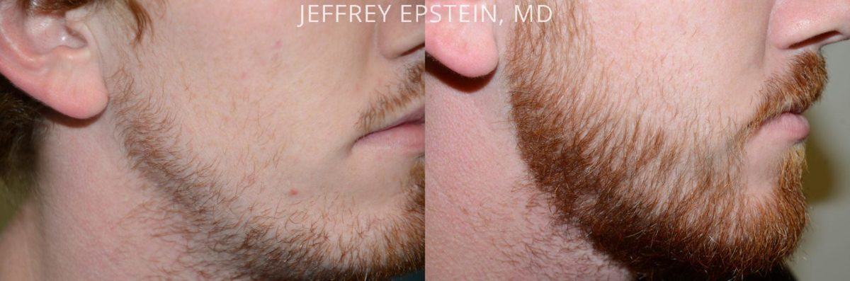 Facial Hair Transplant Before and after in Miami, FL, Paciente 37051