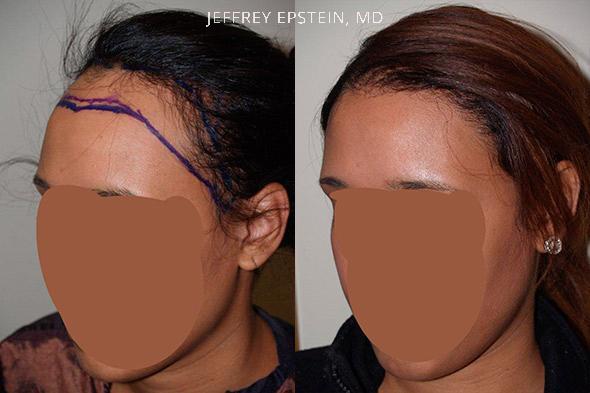 Forehead Reduction Surgery Before and after in Miami, FL, Paciente 37063