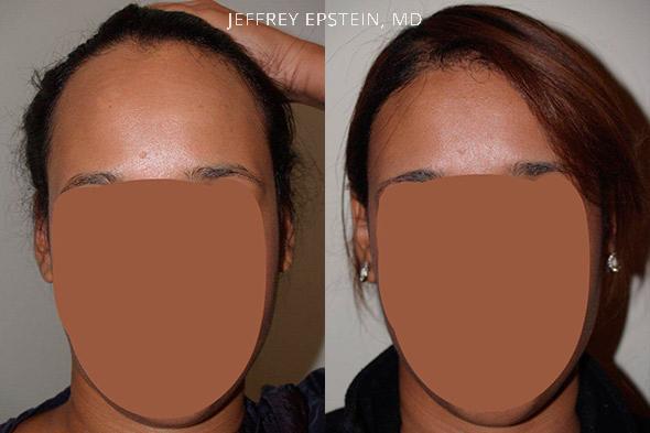 Forehead Reduction Surgery Before and after in Miami, FL, Paciente 37063