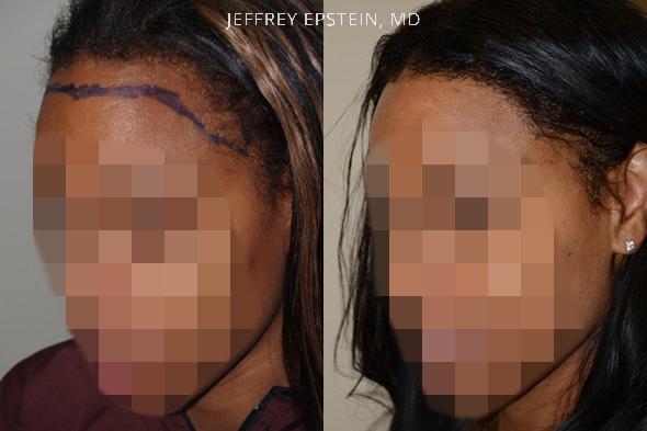 Hairline Advancement Before and after in Miami, FL, Paciente 37068