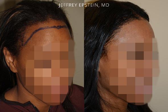 Antes y después del avance de la línea del cabello con injerto de cabello con 1900 injertos