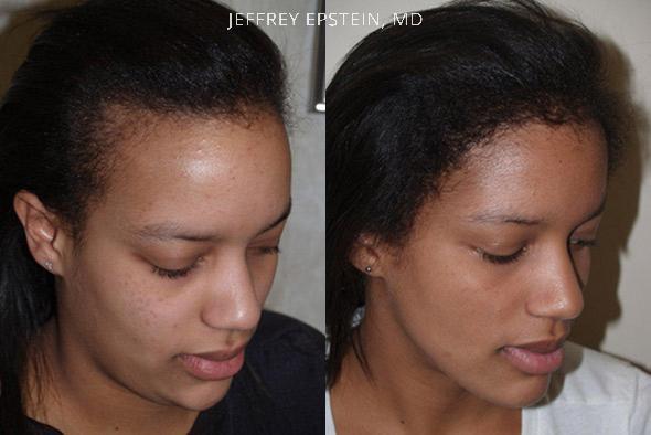 Hairline Advancement Before and after in Miami, FL, Paciente 37073