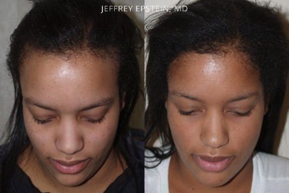 Forehead Reduction Surgery Before and after in Miami, FL, Paciente 37073