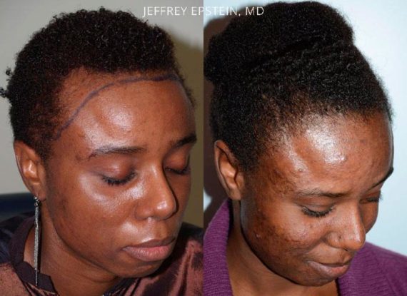 Forehead Reduction Surgery Before and after in Miami, FL, Paciente 37078