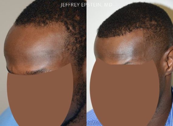 Forehead Reduction Surgery Before and after in Miami, FL, Paciente 37089
