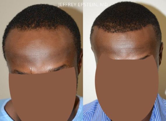 Forehead Reduction Surgery Before and after in Miami, FL, Paciente 37089