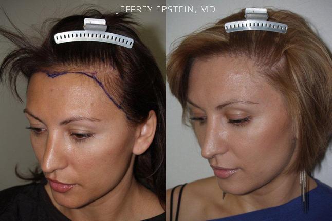 Forehead Reduction Surgery Before and after in Miami, FL, Paciente 37094