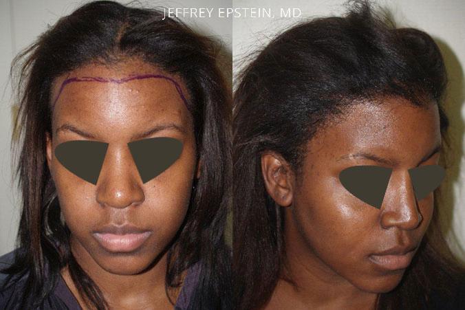 Forehead Reduction Surgery Before and after in Miami, FL, Paciente 37104