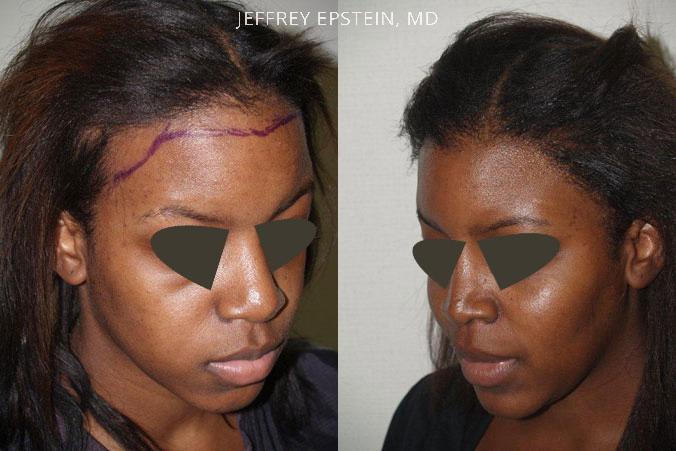 Forehead Reduction Surgery Before and after in Miami, FL, Paciente 37104