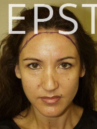 Forehead Reduction Surgery Before and after in Miami, FL, Paciente 37116
