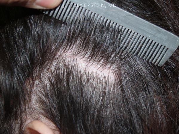 Hairline Advancement Before and after in Miami, FL, Paciente 37123