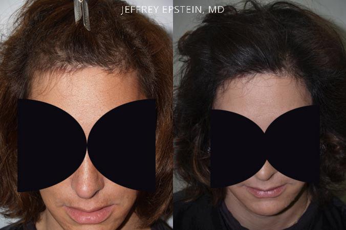 Forehead Reduction Surgery Before and after in Miami, FL, Paciente 37123