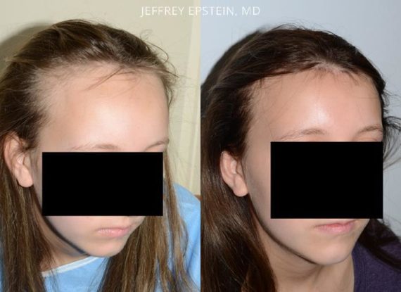Forehead Reduction Surgery Before and after in Miami, FL, Paciente 37129
