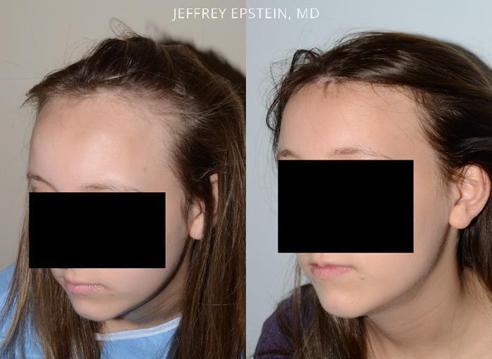 Forehead Reduction Surgery Before and after in Miami, FL, Paciente 37129