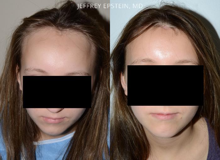 Hairline Advancement Before and after in Miami, FL, Paciente 37129