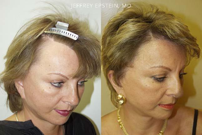 Forehead Reduction Surgery Before and after in Miami, FL, Paciente 37141