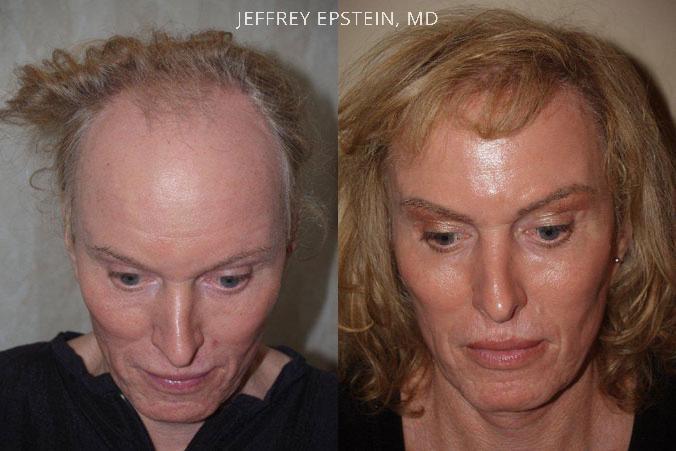 Forehead Reduction Surgery Before and after in Miami, FL, Paciente 37146