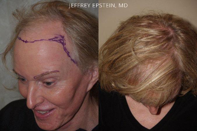 Forehead Reduction Surgery Before and after in Miami, FL, Paciente 37146