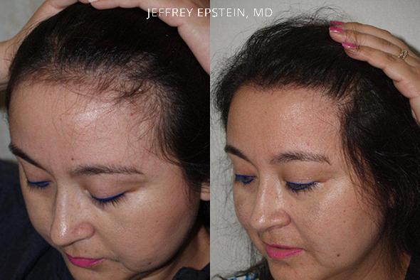 Hairline Advancement Before and after in Miami, FL, Paciente 37157