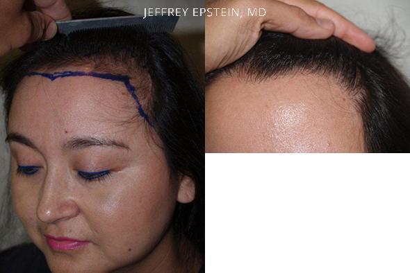 Hairline Advancement Before and after in Miami, FL, Paciente 37157