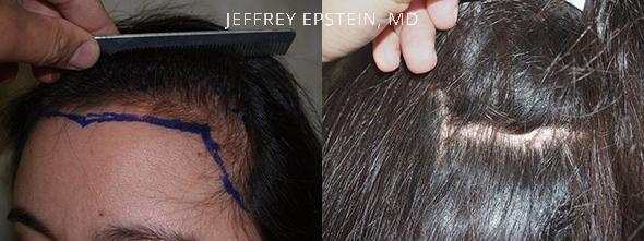 Forehead Reduction Surgery Before and after in Miami, FL, Paciente 37157