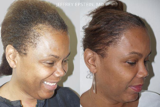 Forehead Reduction Surgery Before and after in Miami, FL, Paciente 37175