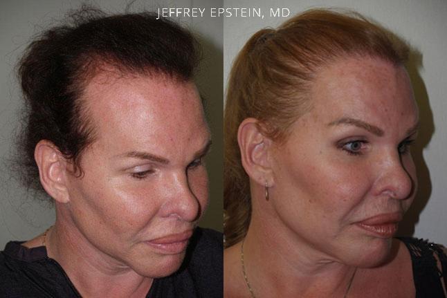Forehead Reduction Surgery Before and after in Miami, FL, Paciente 37180