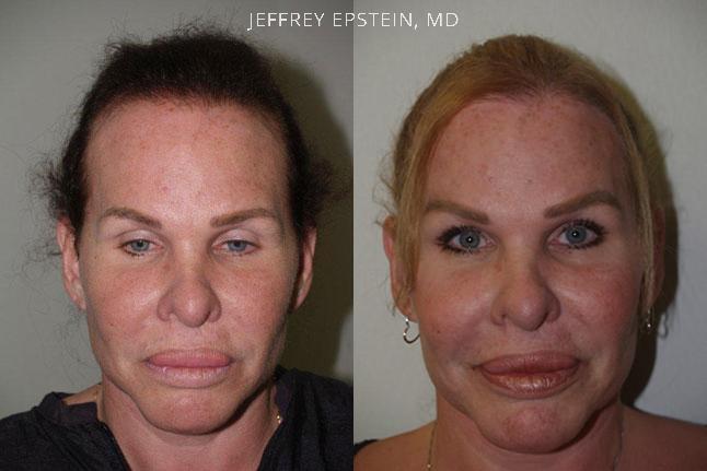Forehead Reduction Surgery Before and after in Miami, FL, Paciente 37180
