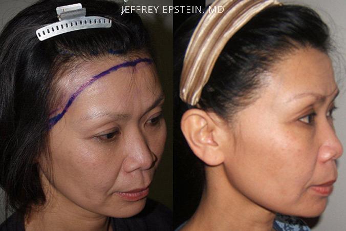Forehead Reduction Surgery Before and after in Miami, FL, Paciente 37195