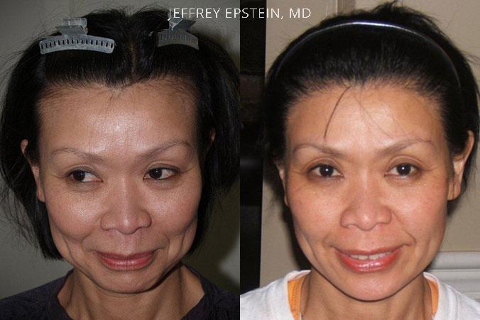 Forehead Reduction Surgery Before and after in Miami, FL, Paciente 37195