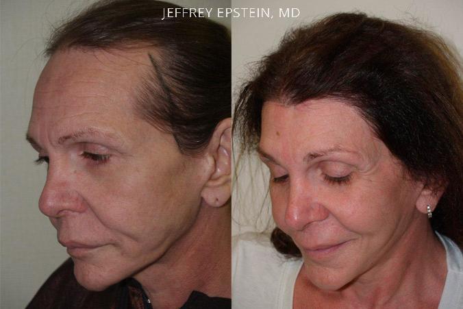 Forehead Reduction Surgery Before and after in Miami, FL, Paciente 37217