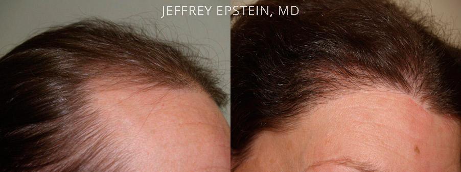 Hairline Advancement Before and after in Miami, FL, Paciente 37217