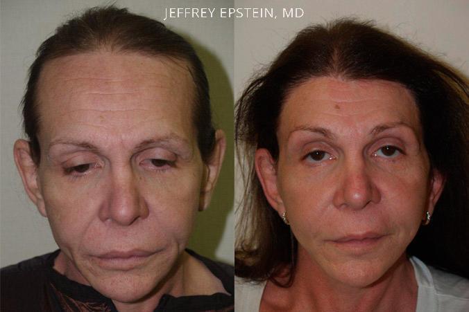 Forehead Reduction Surgery Before and after in Miami, FL, Paciente 37217