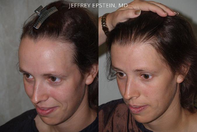 Hairline Advancement Before and after in Miami, FL, Paciente 37226