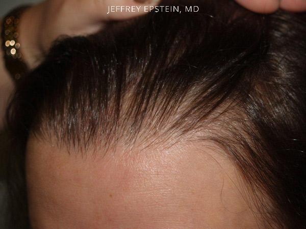 Hairline Advancement Before and after in Miami, FL, Paciente 37226