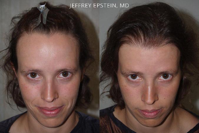 Forehead Reduction Surgery Before and after in Miami, FL, Paciente 37226