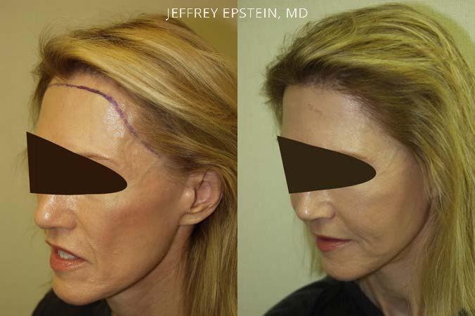 Forehead Reduction Surgery Before and after in Miami, FL, Paciente 37234