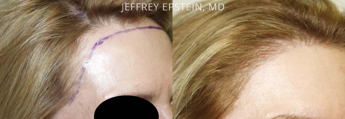 Hairline Advancement Before and after in Miami, FL, Paciente 37234