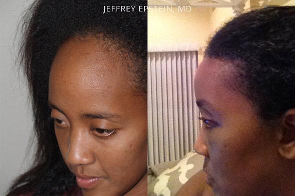 Hairline Advancement Before and after in Miami, FL, Paciente 37252