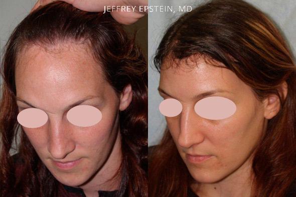 Forehead Reduction Surgery Before and after in Miami, FL, Paciente 37260