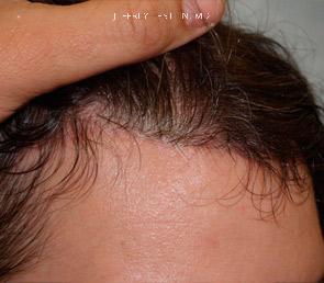Forehead Reduction Surgery Before and after in Miami, FL, Paciente 37260