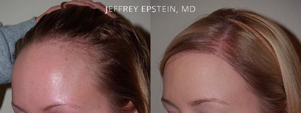 Forehead Reduction Surgery Before and after in Miami, FL, Paciente 37268