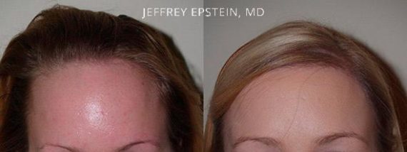 Forehead Reduction Surgery Before and after in Miami, FL, Paciente 37268